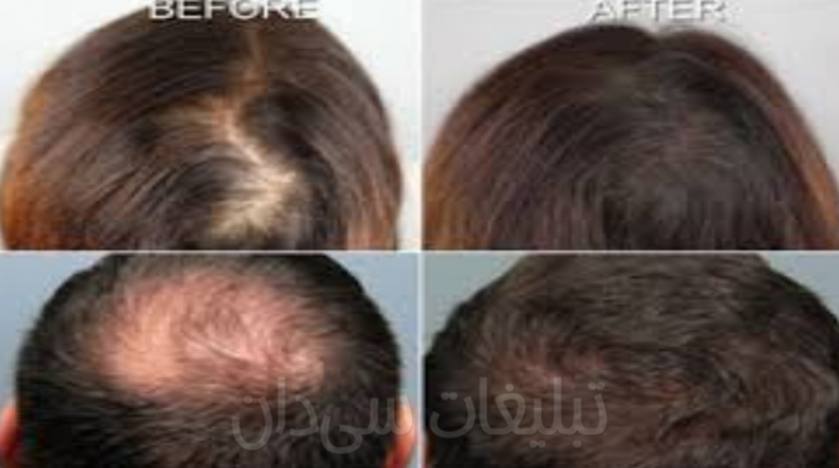 مزوتراپی درمان قطعی ریزش مو+پُر پشتی مو در منزل شما