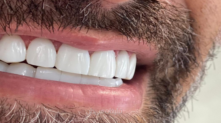 دندانپزشکی زیبایی کامپوزیت لمینت
