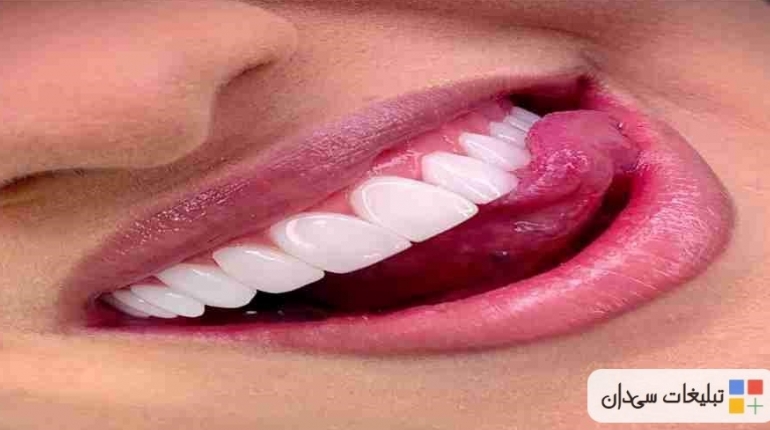 روکش دندان لمینت سرامیکی کامپوزیت دندان دندانپزشکی