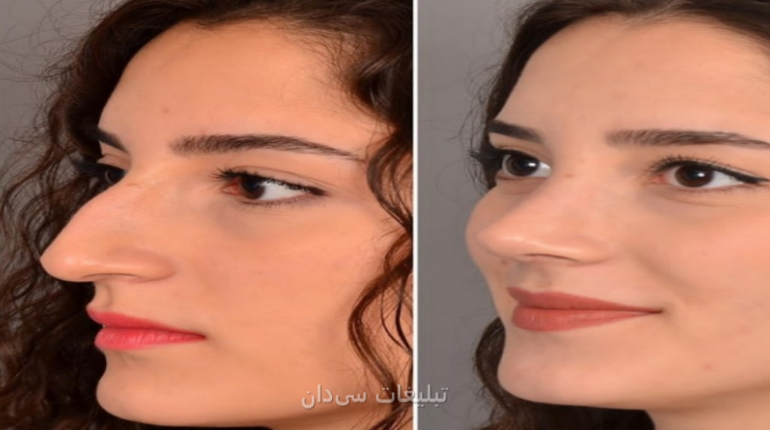 جراحی زیبایی بینی و پلک